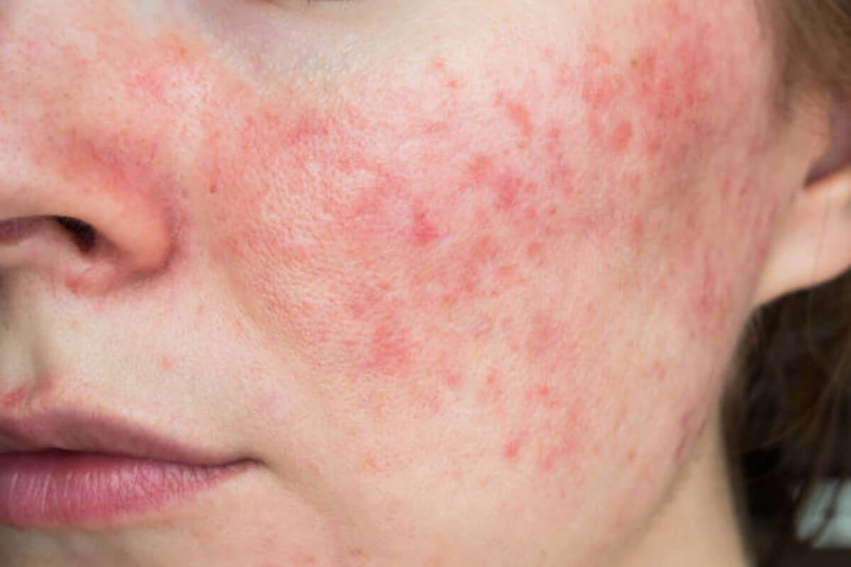 trị sẹo mụn